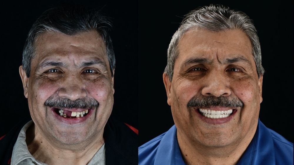 Side-by-side portraits: man with missing teeth on left, smiling with full, white teeth on right.