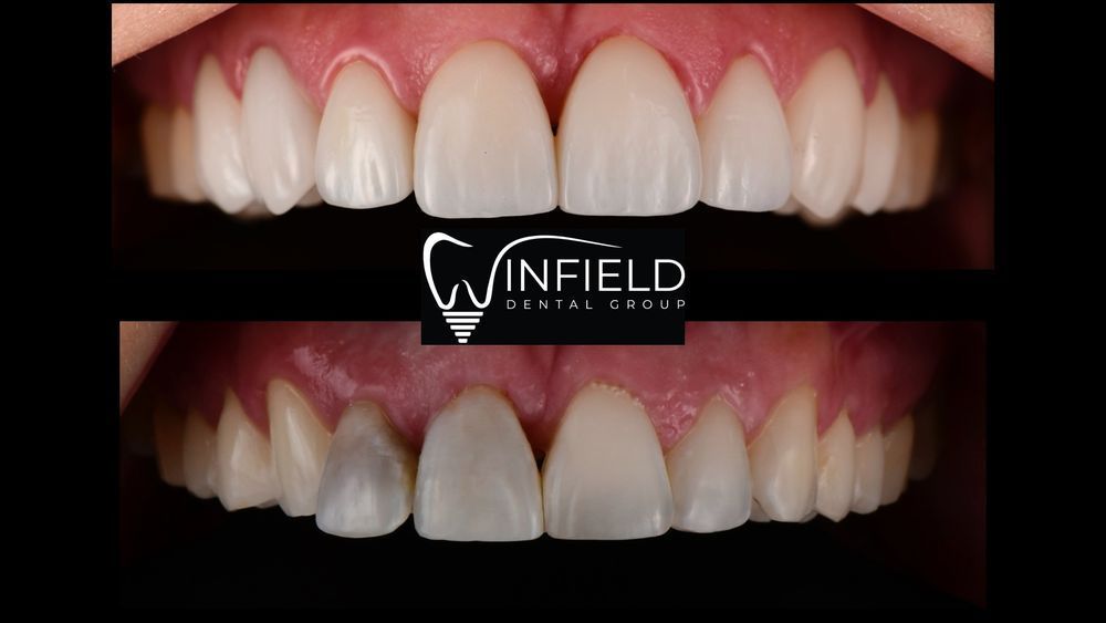 Comparison of teeth: top row shows bright, white teeth, bottom row shows stained teeth.