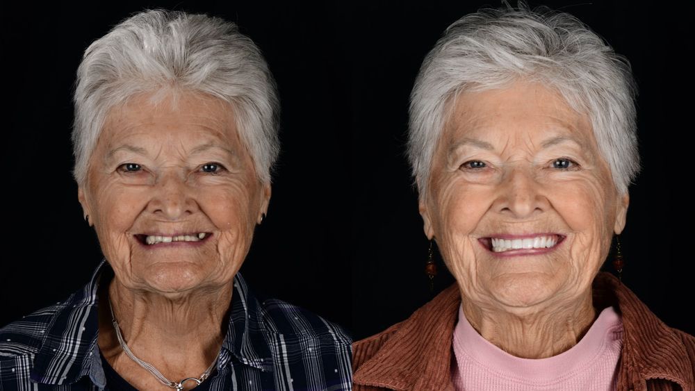 Before-and-after of a woman's smile. The right photo shows a brighter, wider smile with a dental enhancement.