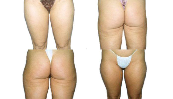 Kūno kontūrų modeliavimas