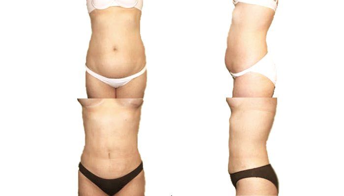 Kūno kontūrų modeliavimas