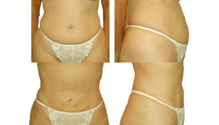 Kūno kontūrų modeliavimas