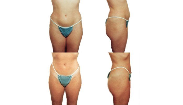 Kūno kontūrų modeliavimas