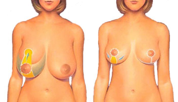 Krūtų sumažinimas