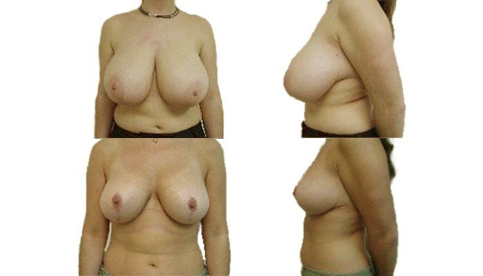 Krūtų sumažinimas