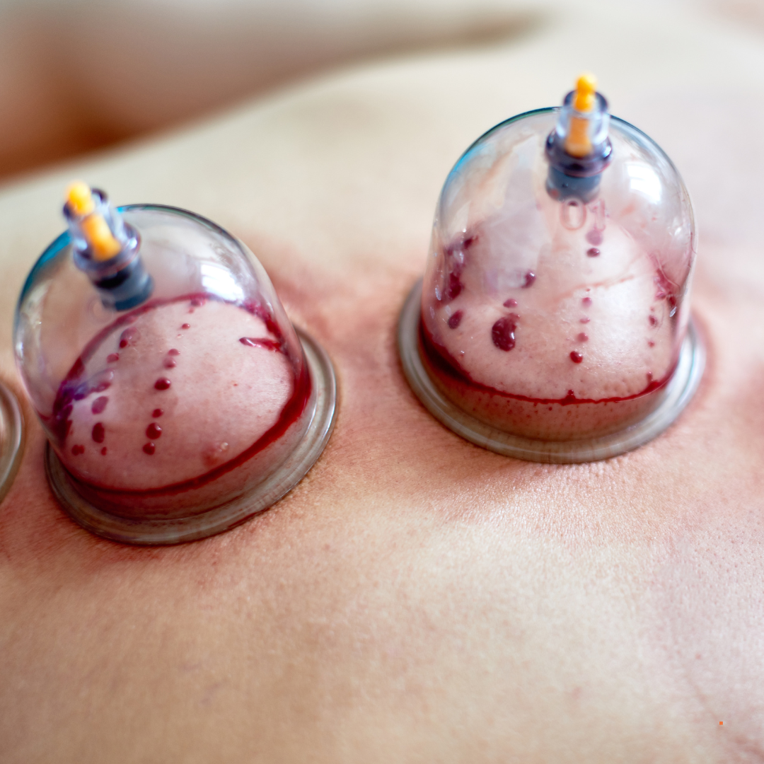 A person is getting cupping treatment on their back.