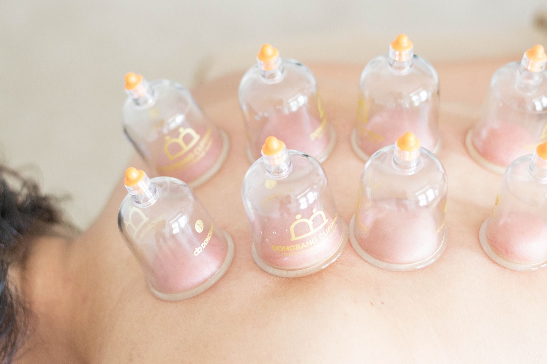 A person is getting cupping treatment on their back.