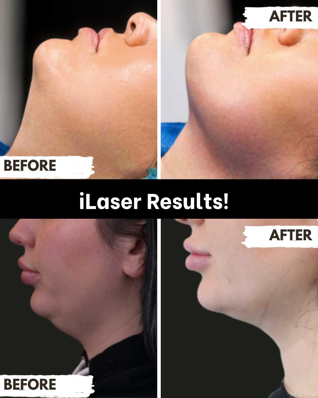 Before and after comparison showing facial contouring 