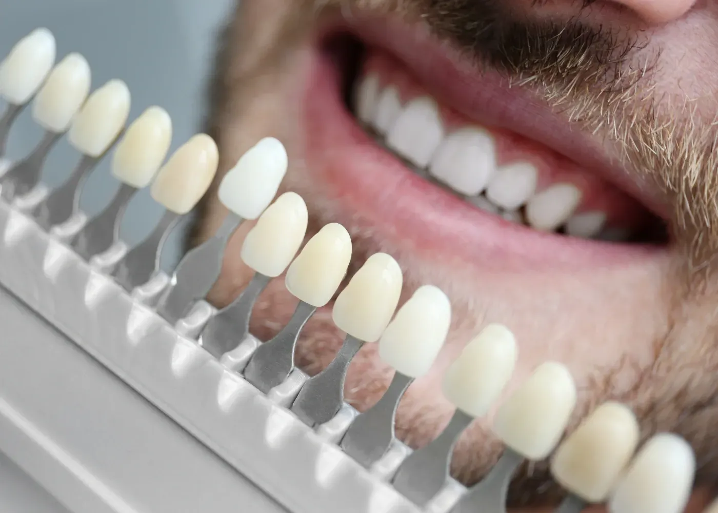 Un gros plan des dents d'un homme avec un nuancier de dents.