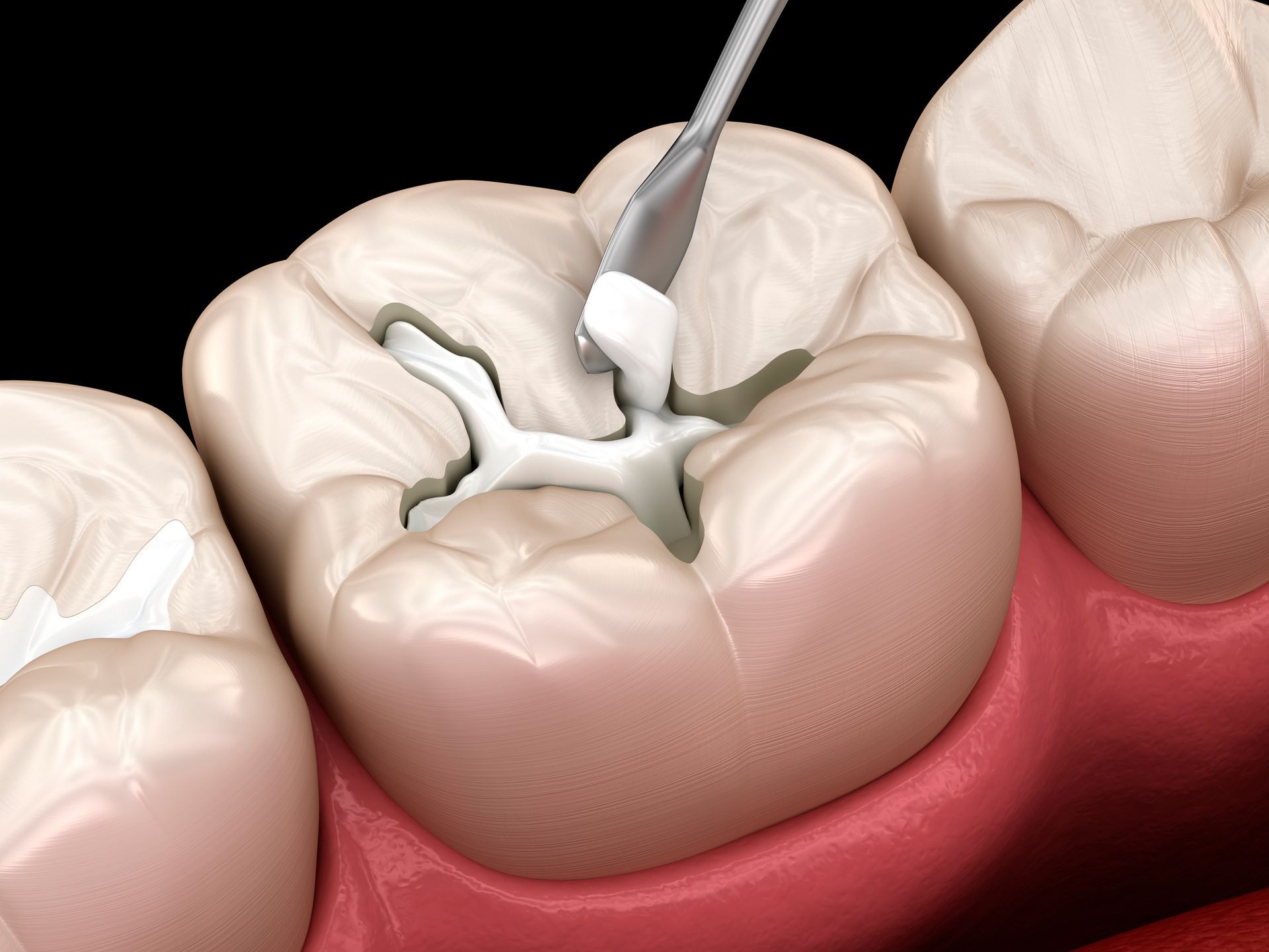 Dental Cavitation Treatment