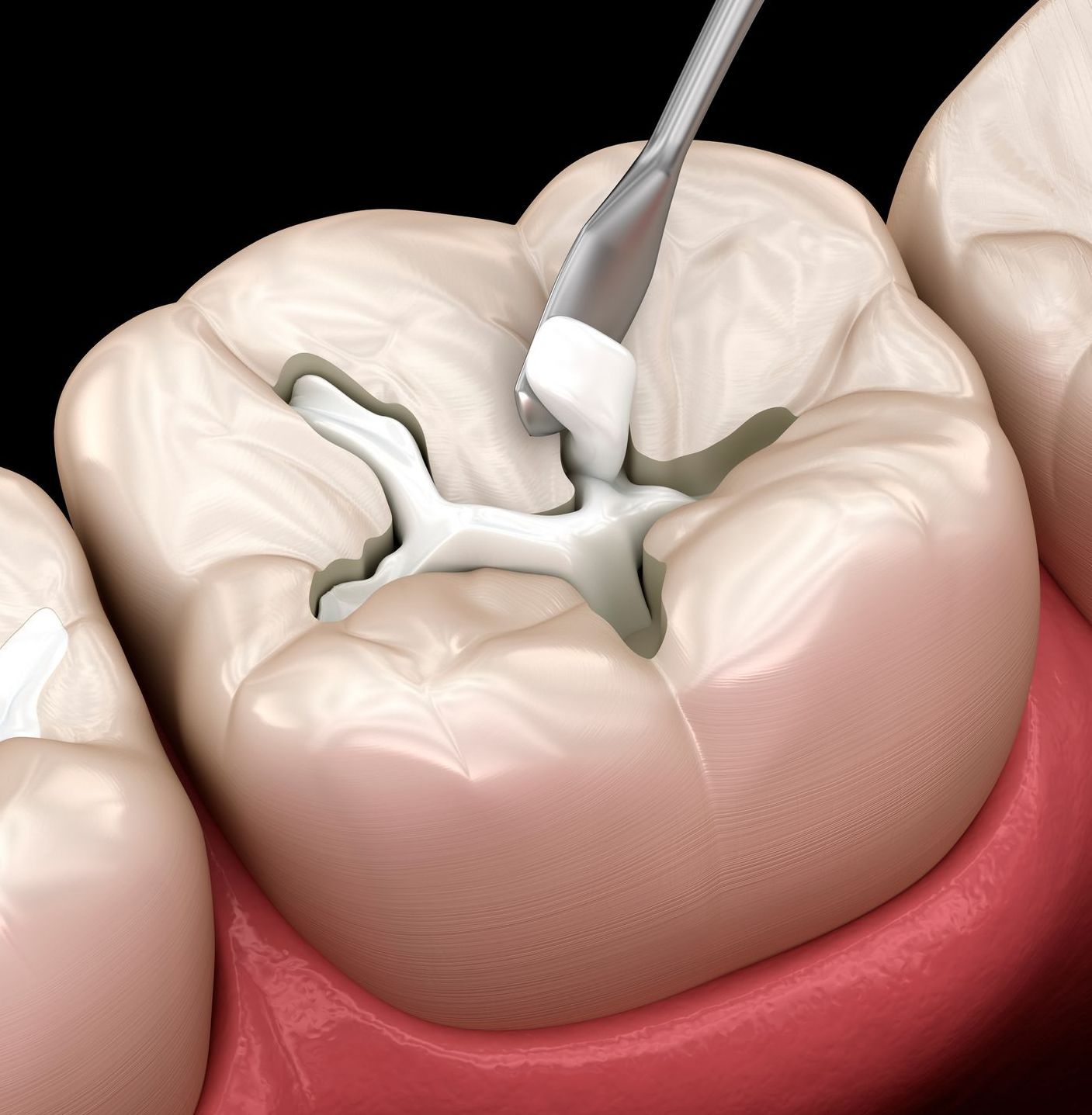 Close-up view of dental cavitation