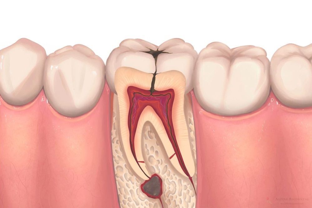 Cross-section of tooth with cavity and root infection highlighted.