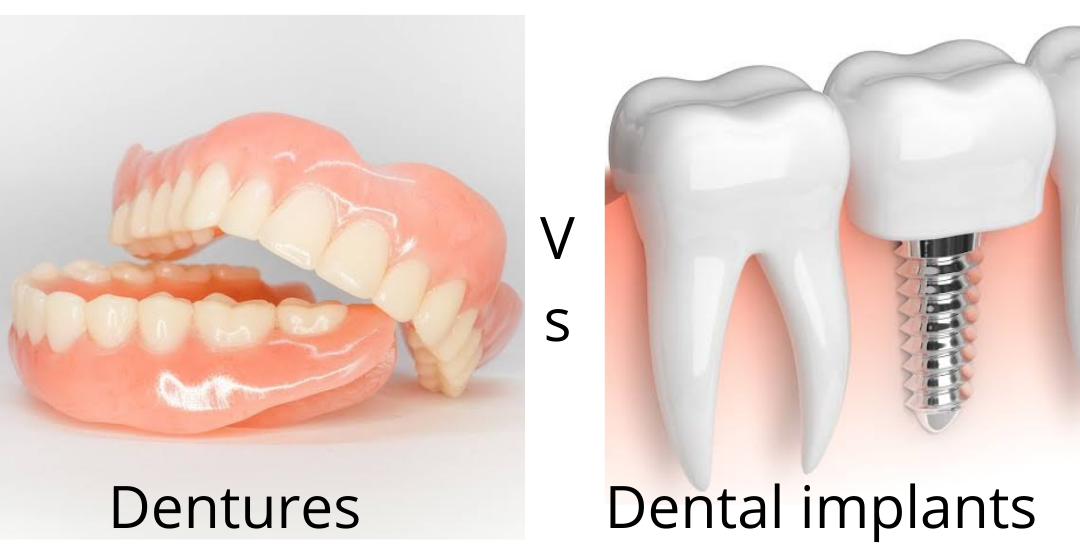 A picture of a denture and a picture of dental implants
