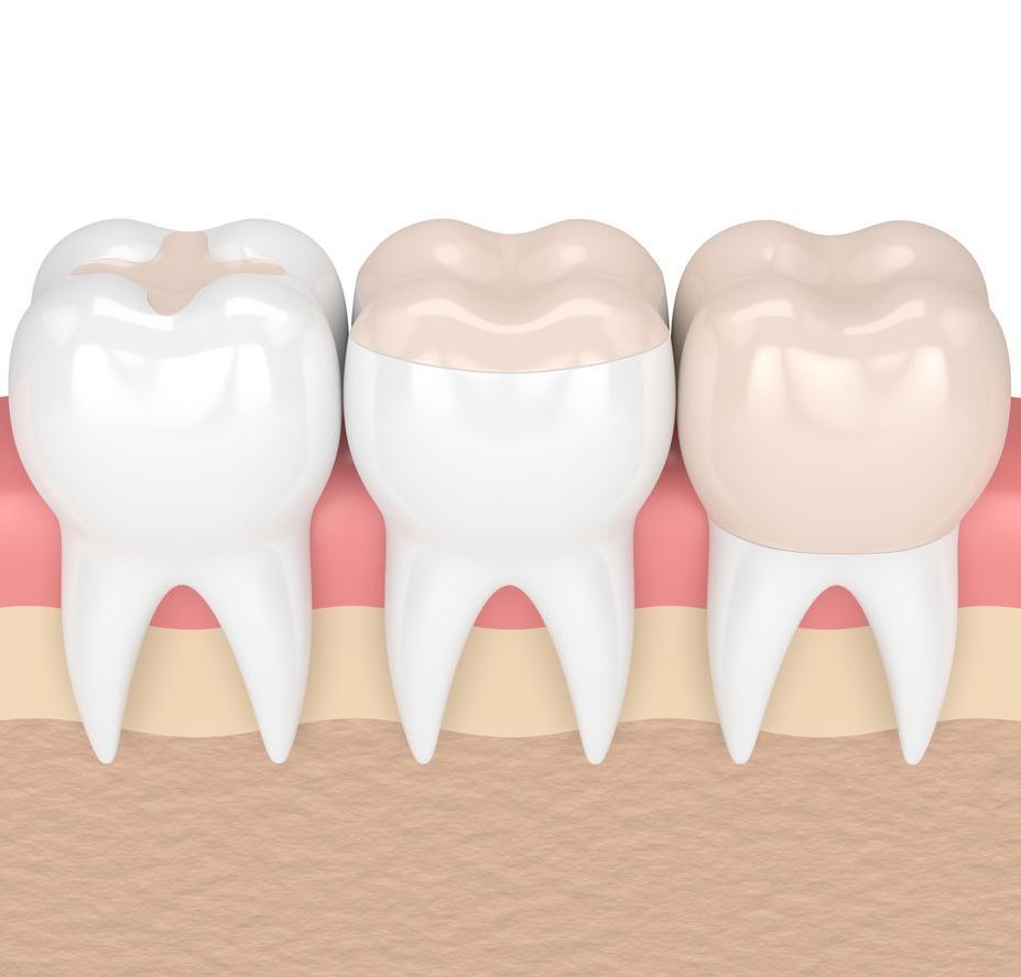 Dental onlays and inlays