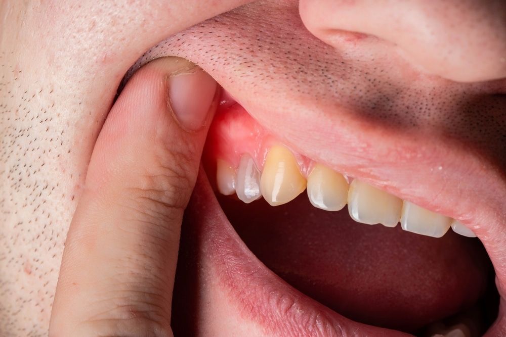 Close-up of a person's mouth showing an inflamed gum near a tooth being touched by a finger.