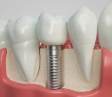Dental Implants