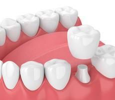 Dental Crowns