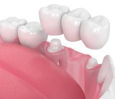 Dental Bridges