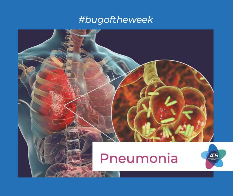 Pneumonia -Infection Prevention and Control