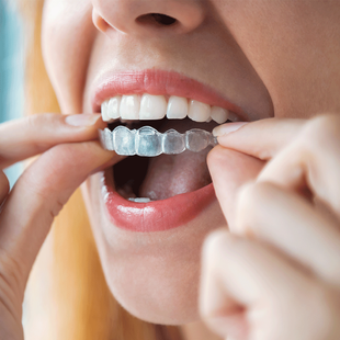 a woman is putting a clear brace on her teeth