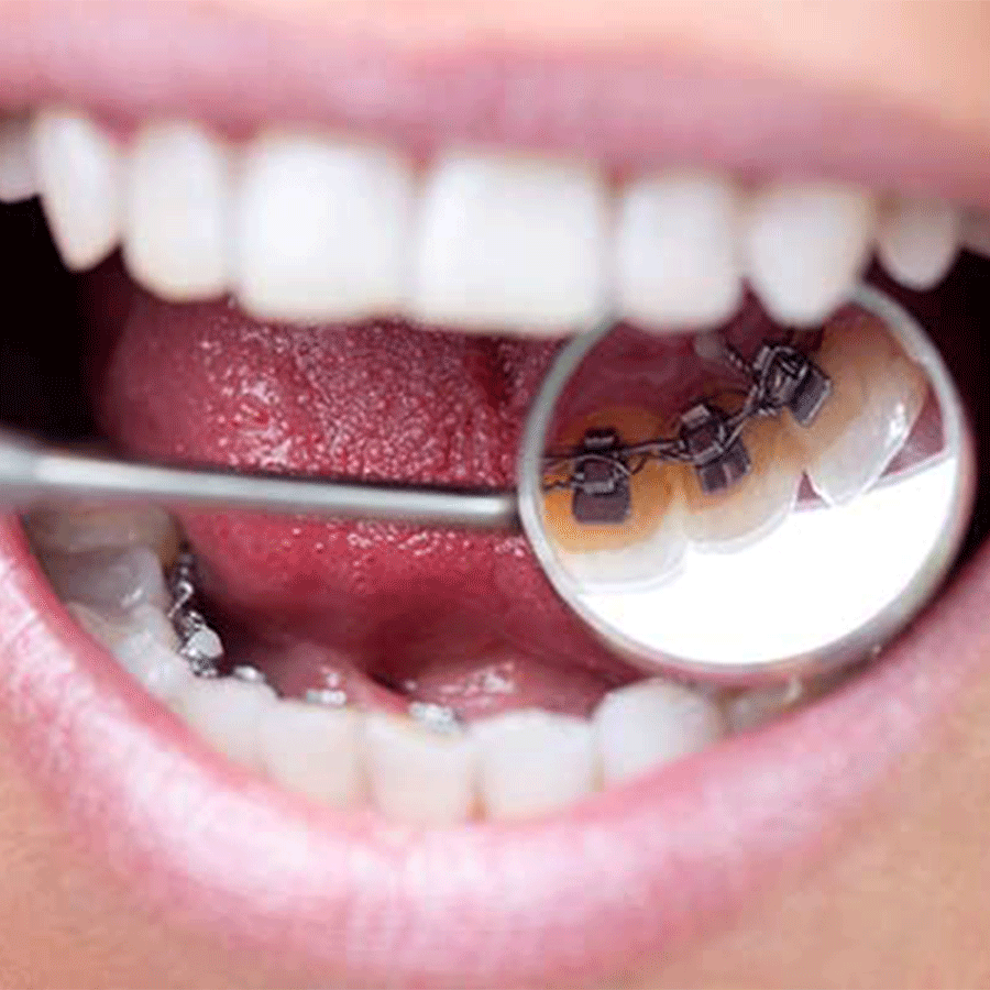 a close up of a person 's mouth with braces on their teeth .