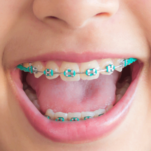 a close up of a person 's teeth with green braces