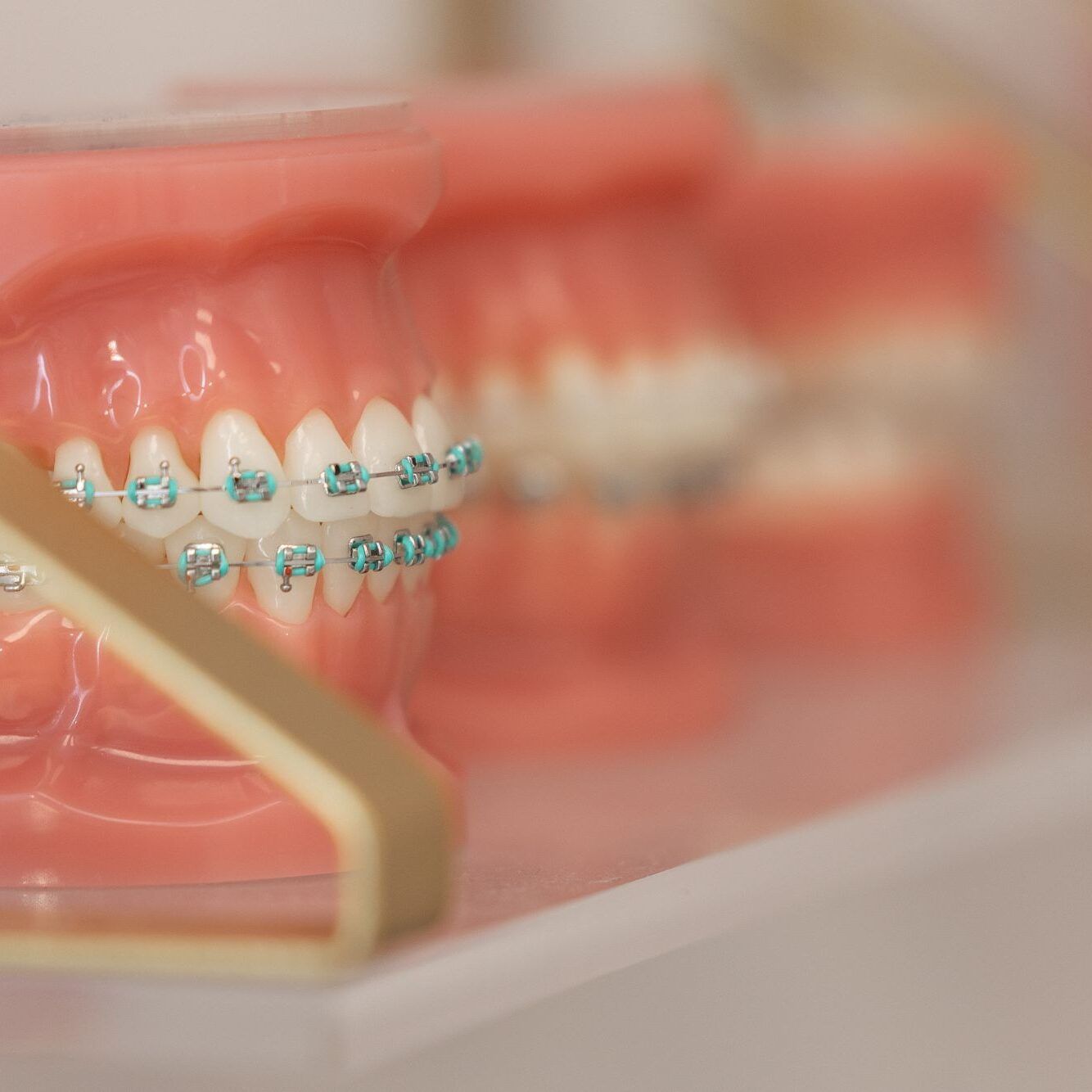 a close up of a model of teeth with blue braces