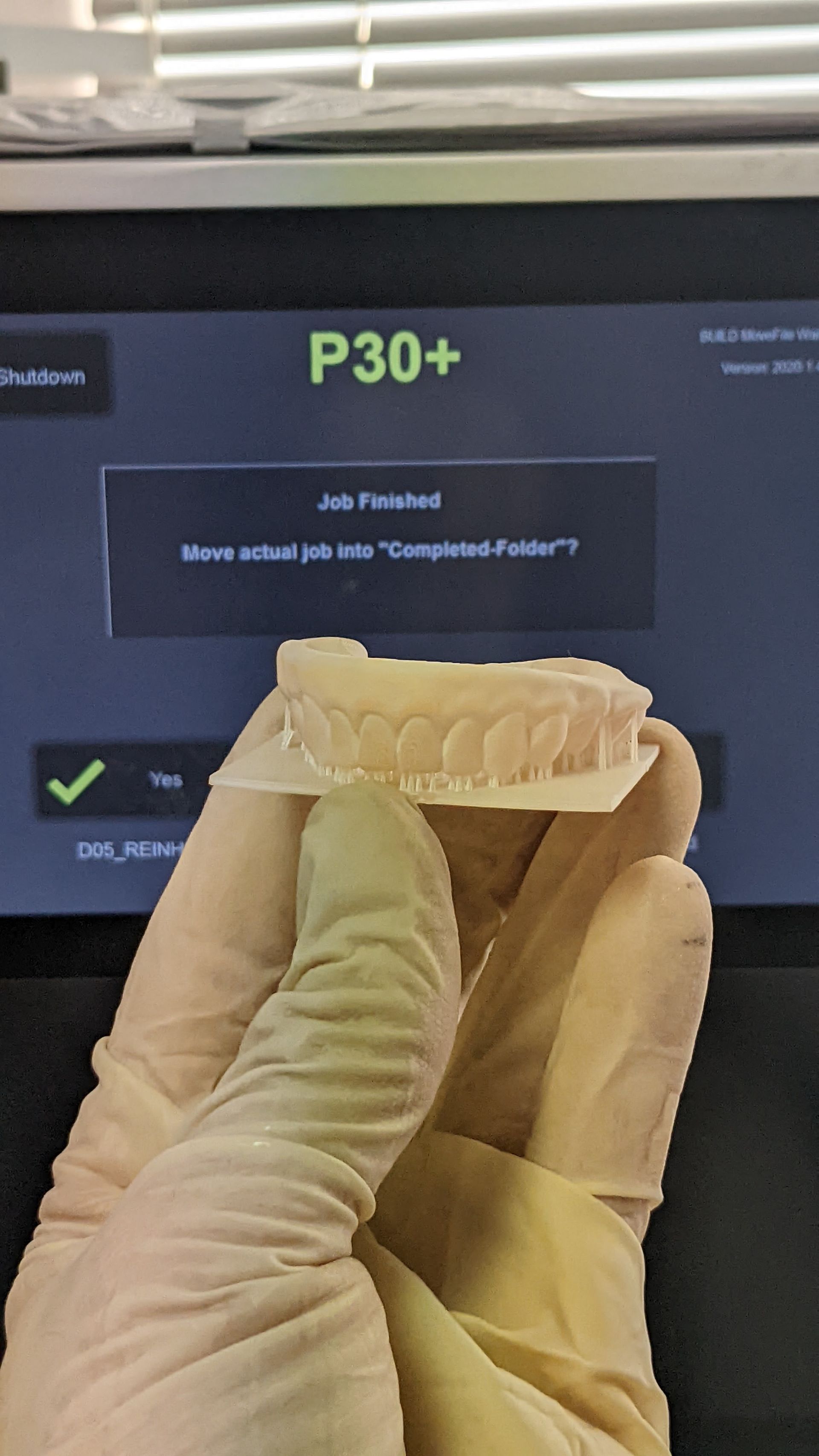 Hybrid Denture 3d Print