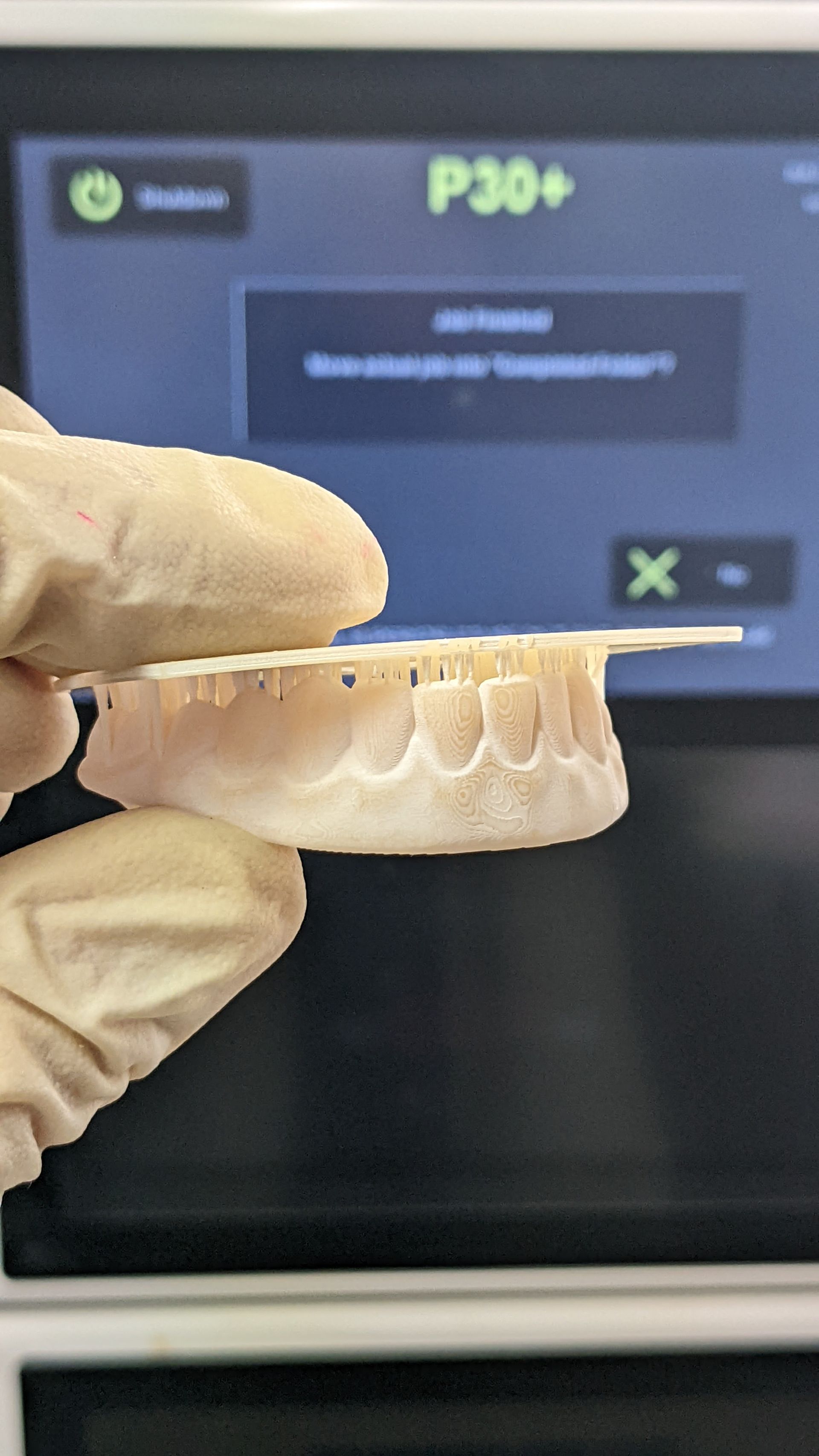 Hybrid Denture 3d Print