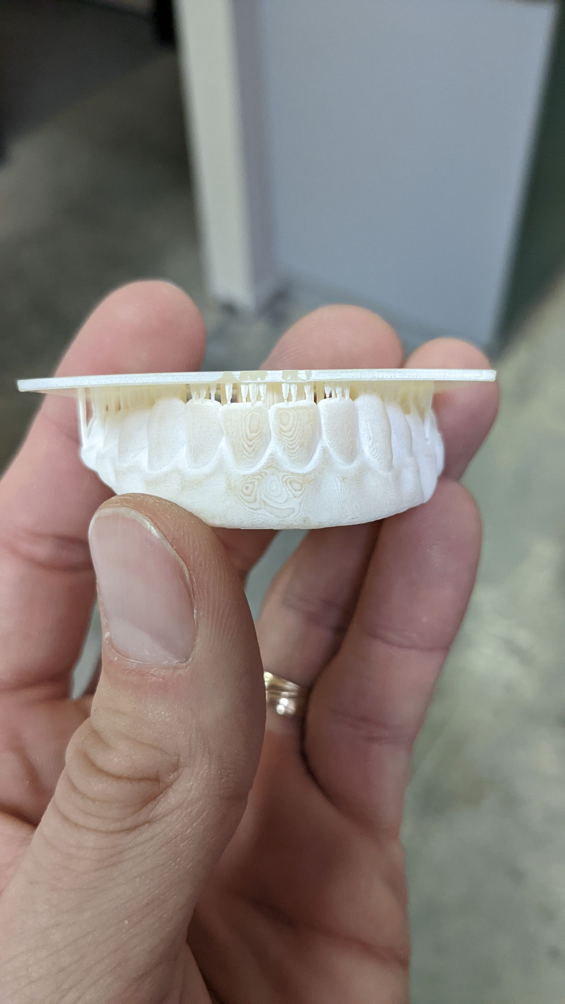 Hybrid Denture 3d Print