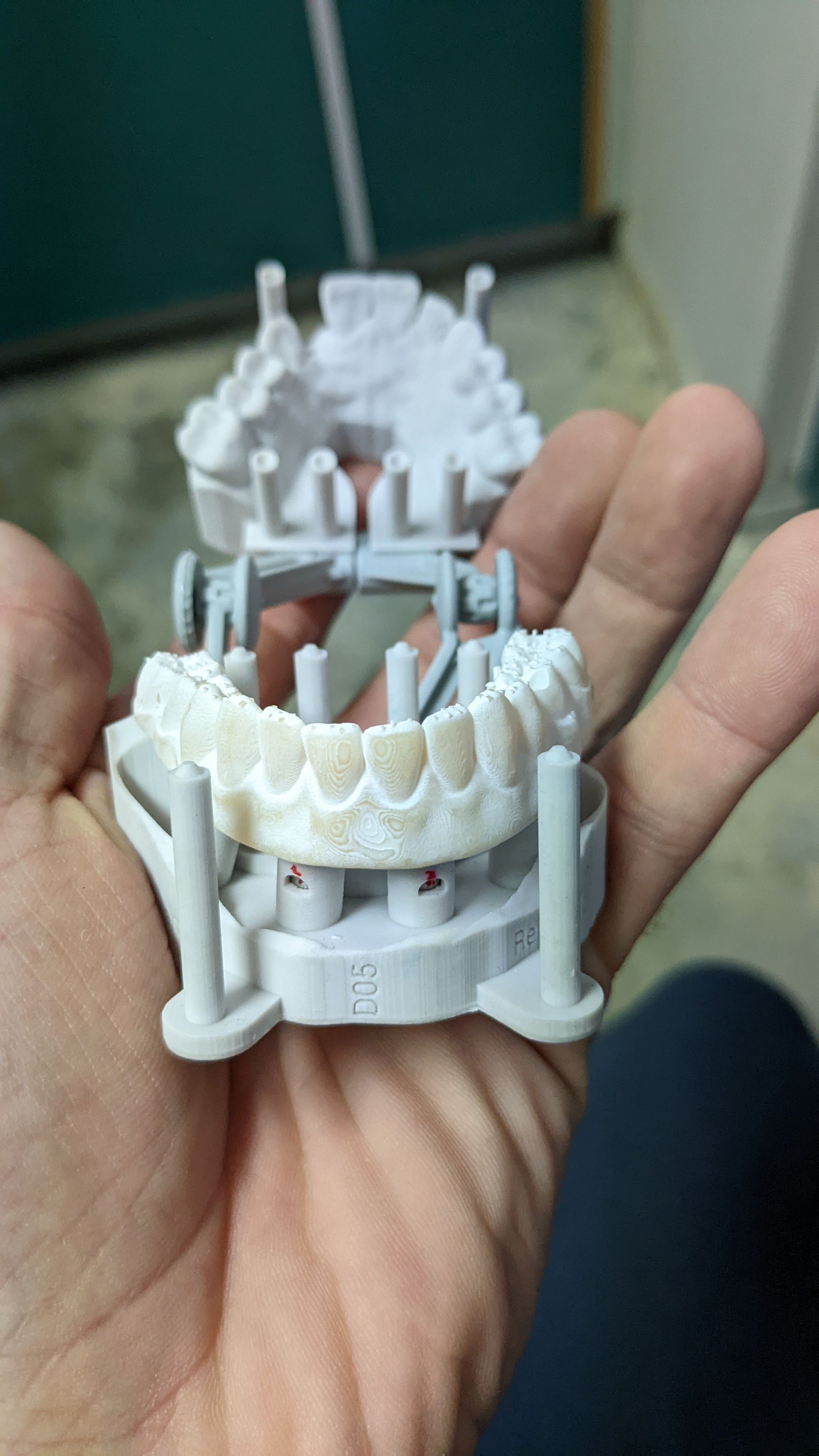 Hybrid Denture