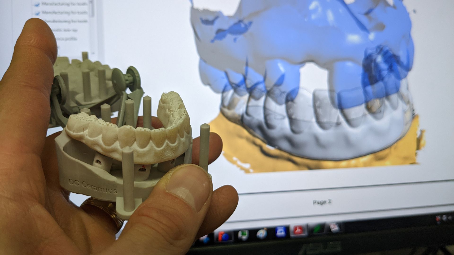 Hybrid Denture