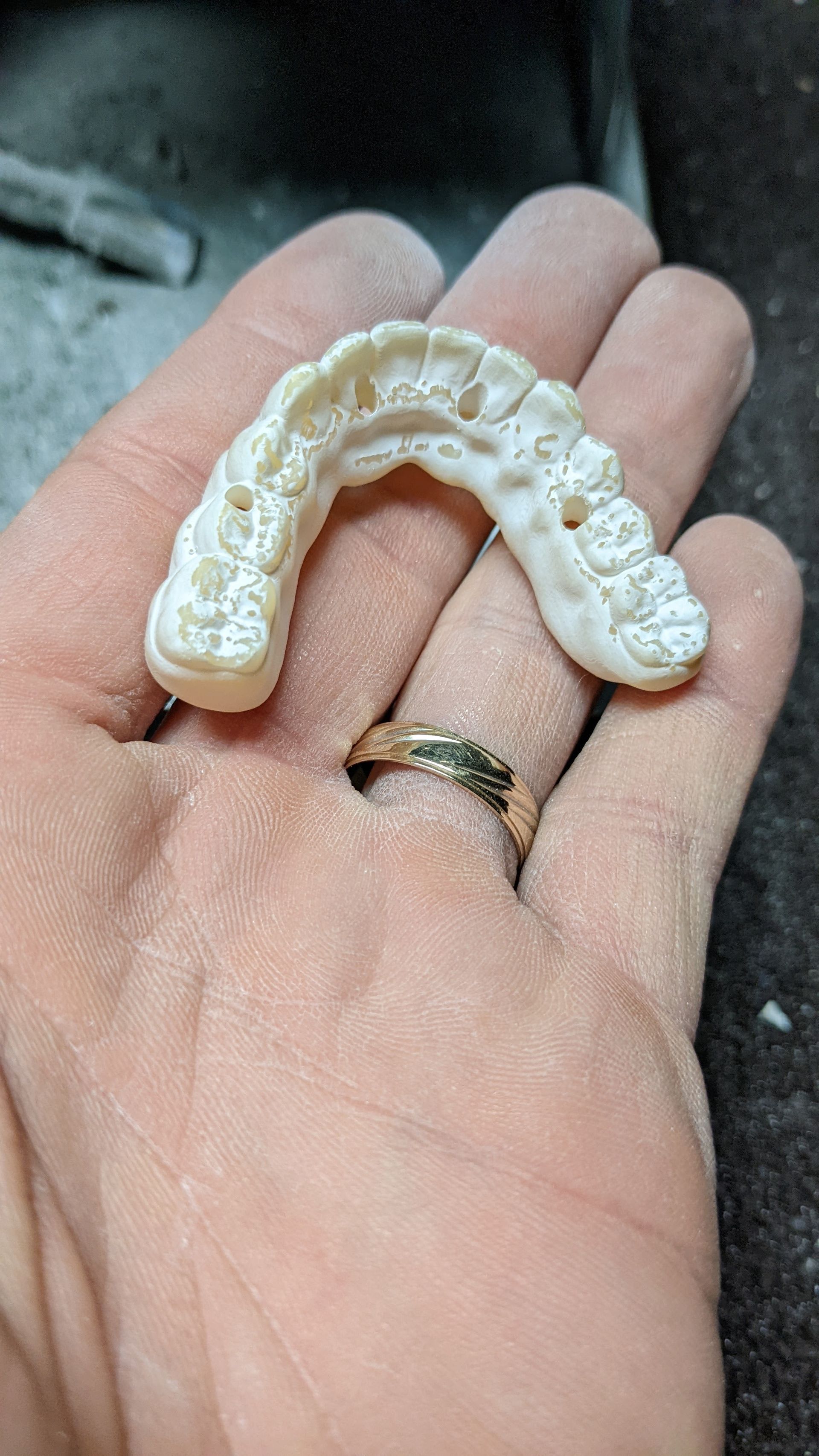 Hybrid Denture