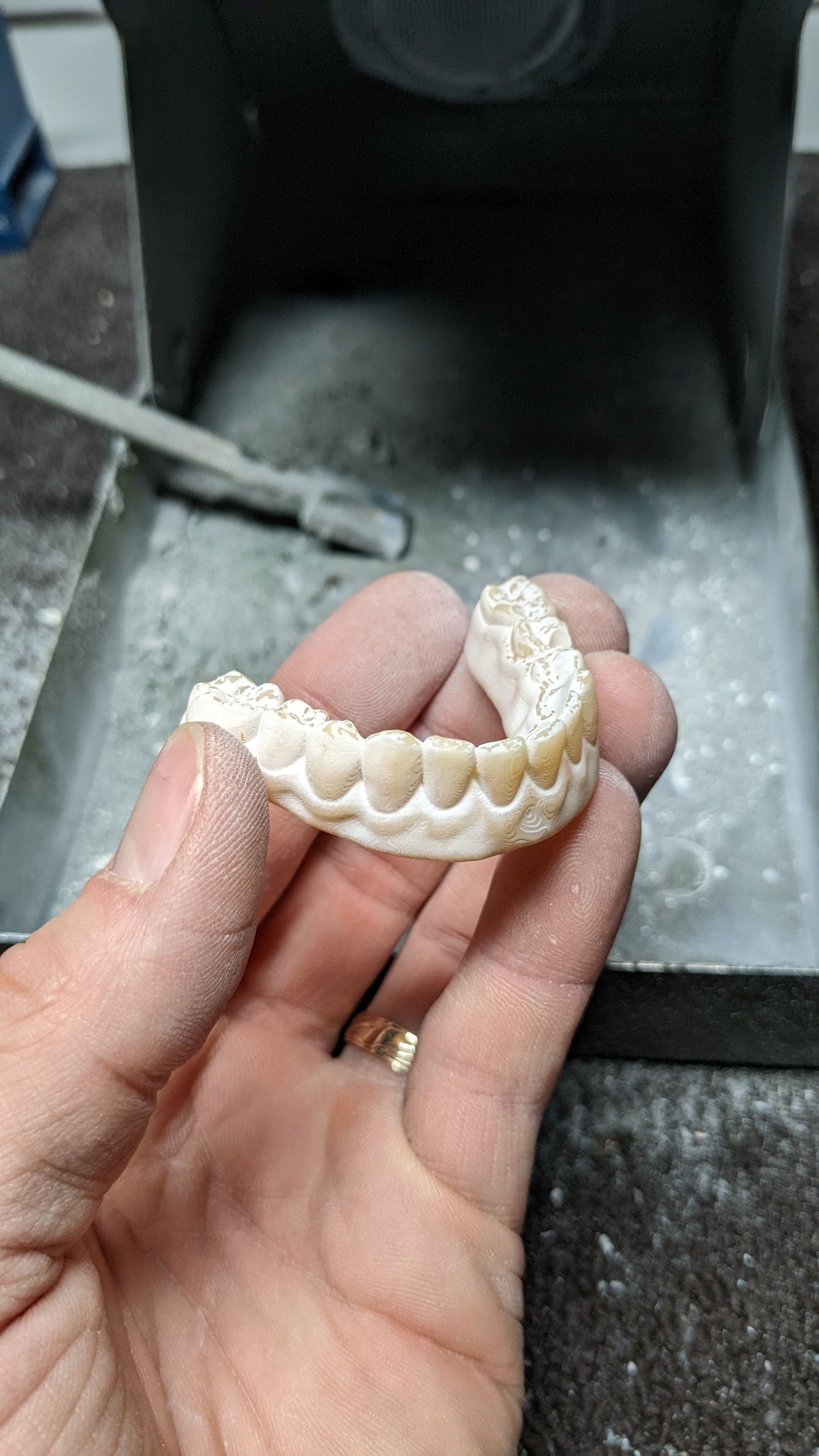 Hybrid Denture