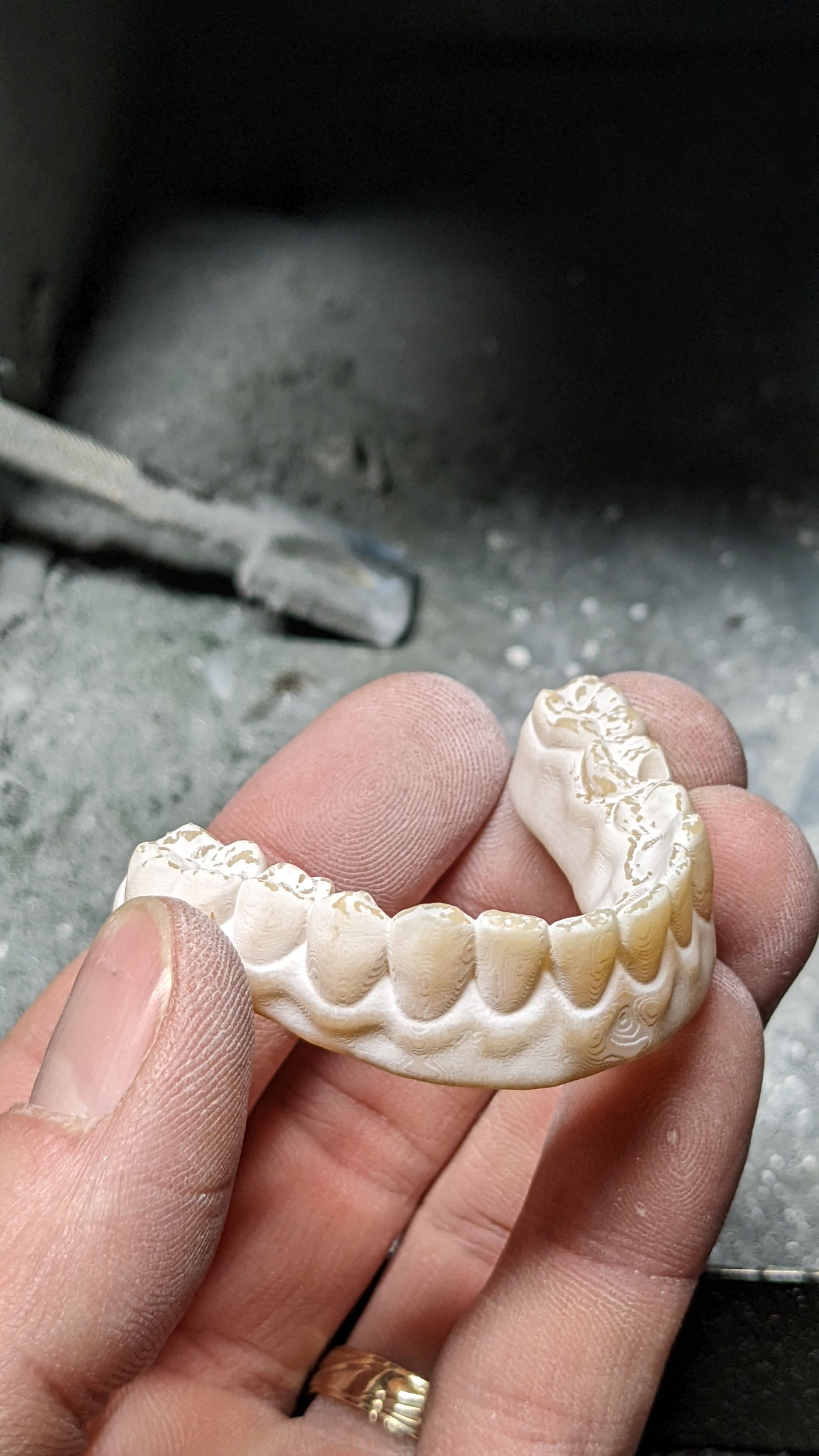 Hybrid Denture
