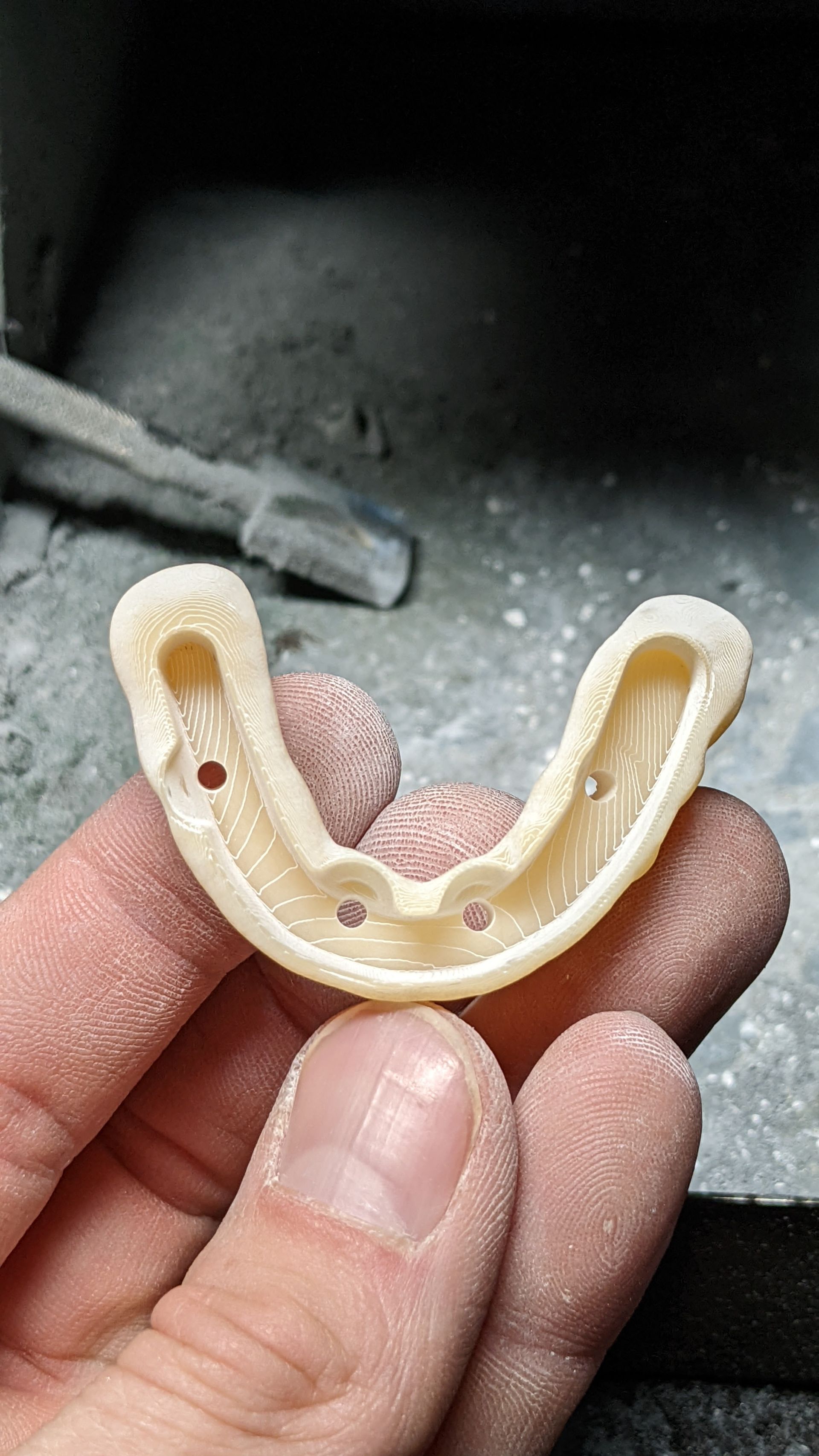 Hybrid Denture