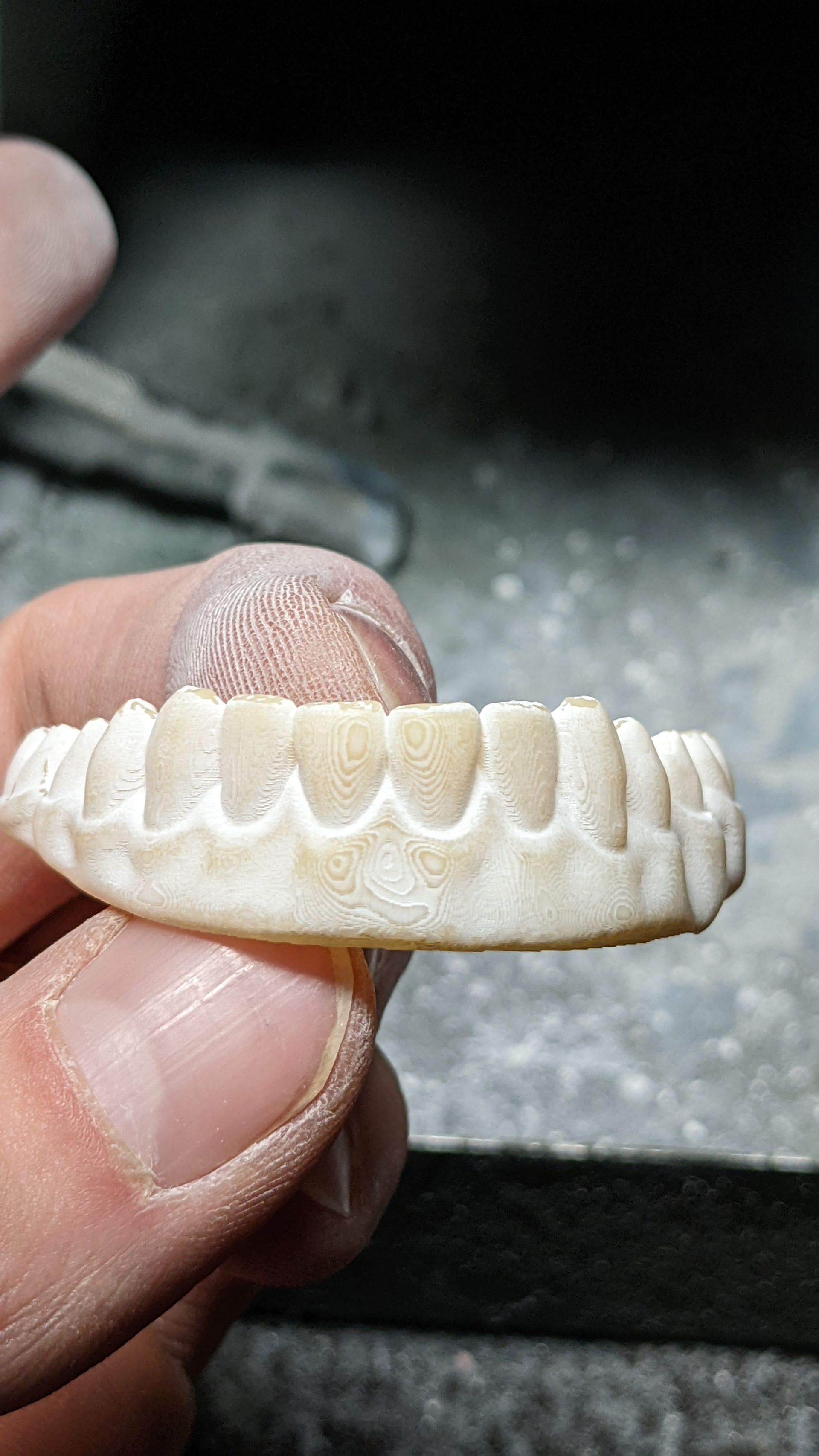 Hybrid Denture