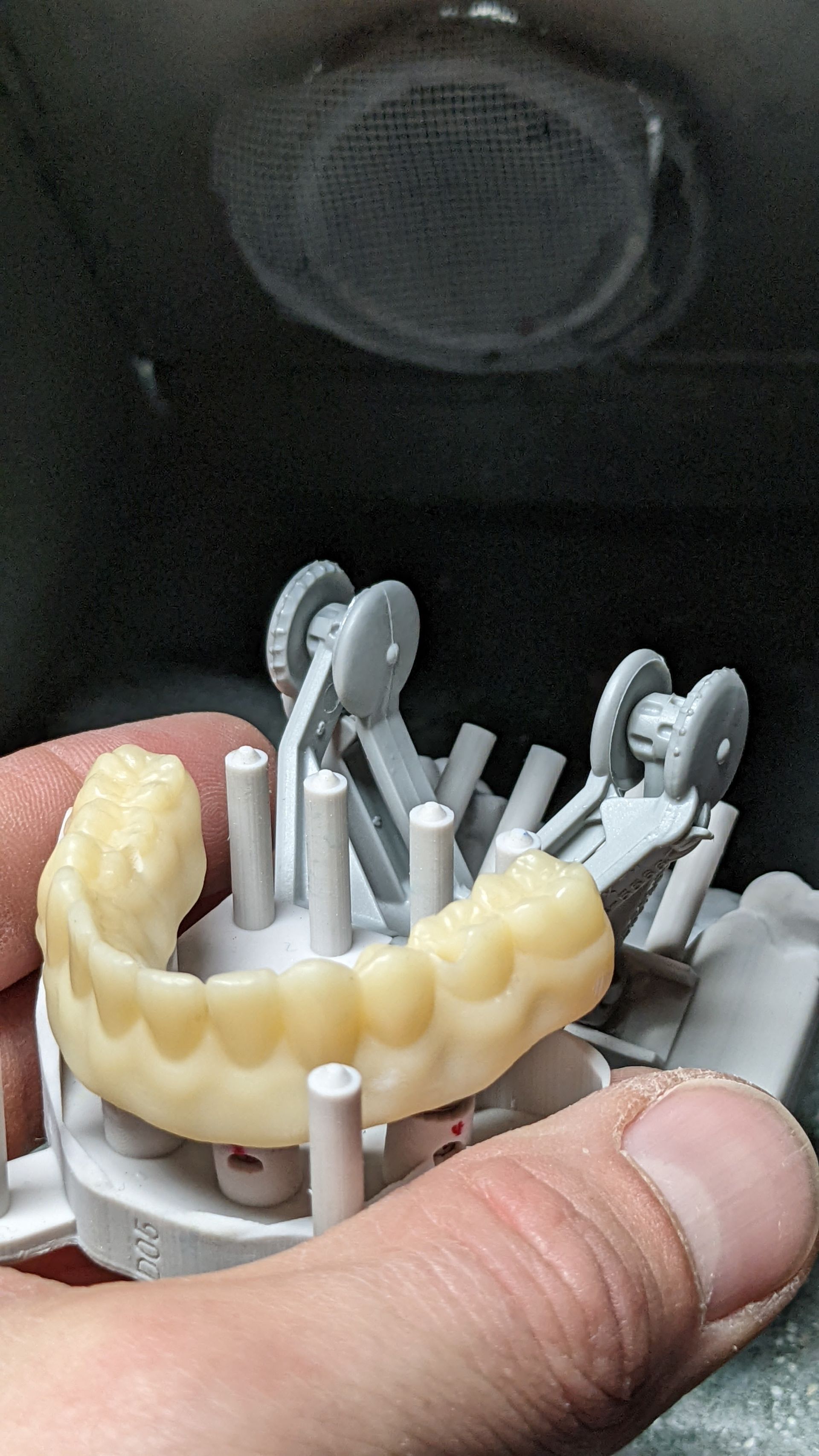 Hybrid Denture