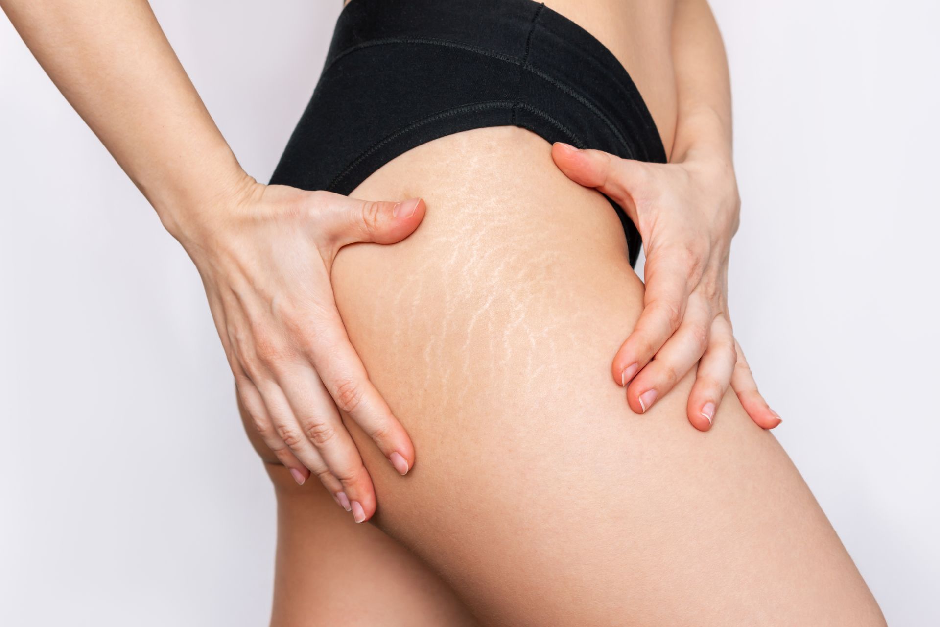 A woman is holding her leg with stretch marks on it.