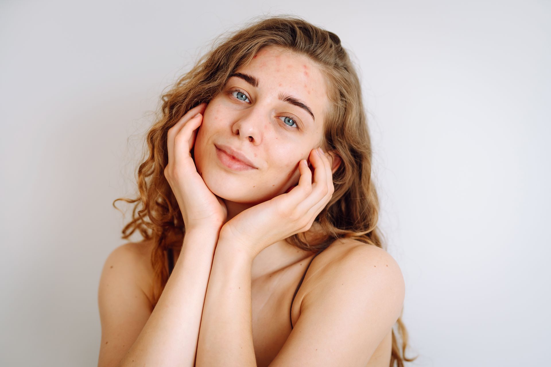 A woman with acne on her face is touching her face with her hands.