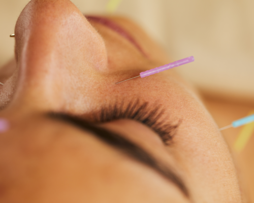 A close up of a woman getting acupuncture on her face