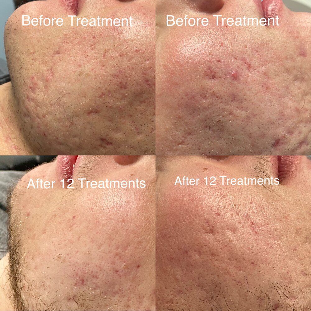 A before and after photo of a man 's face with acne.