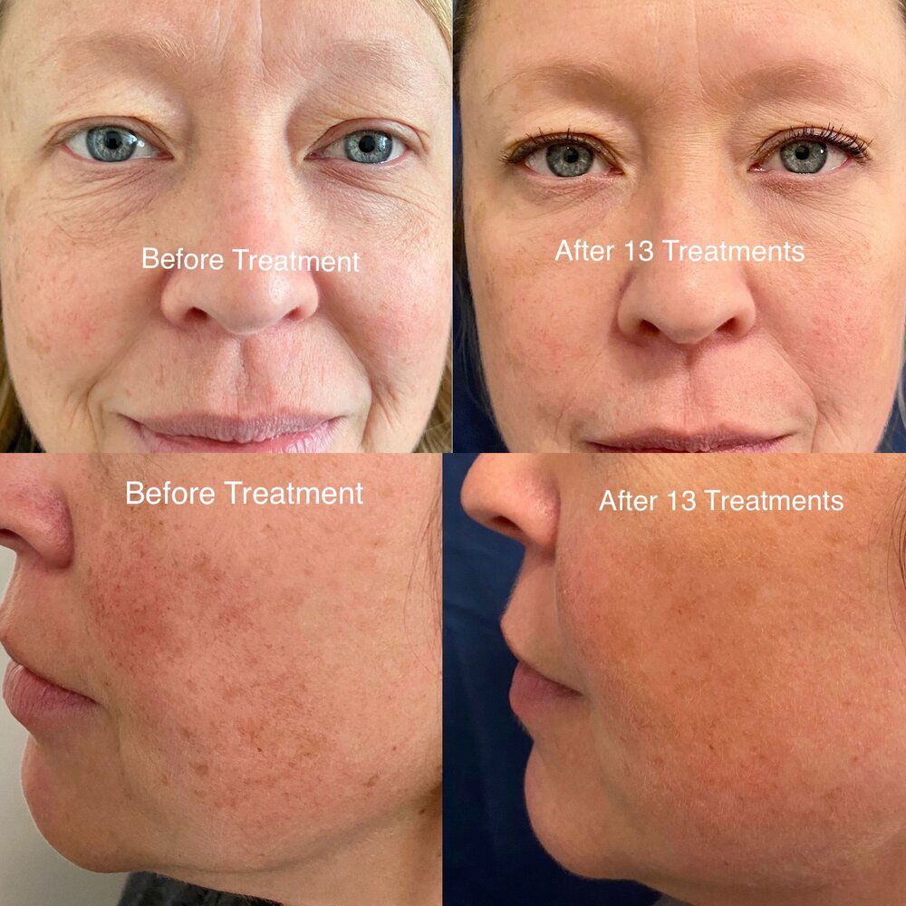 A woman 's face before and after 13 treatments.