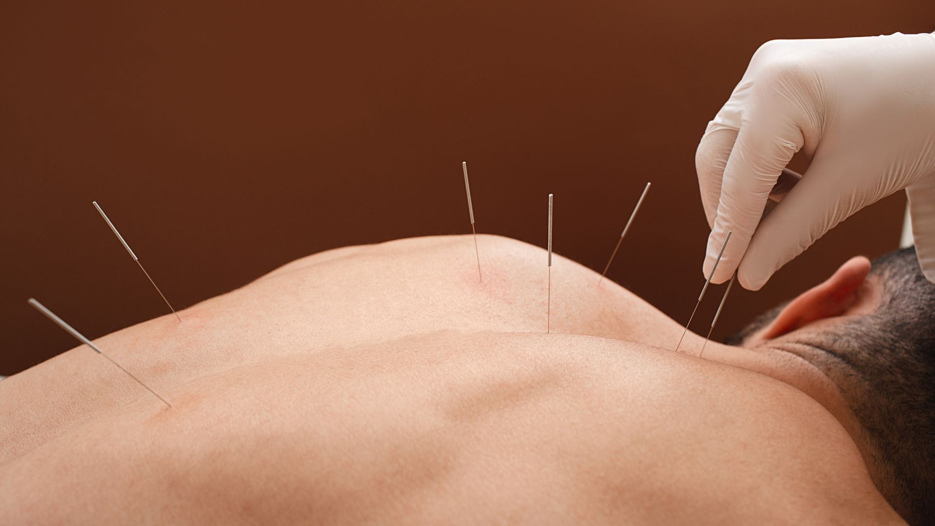 Acupuncture needles inserted along a person's bare upper back and neck, with a gloved hand placing one needle