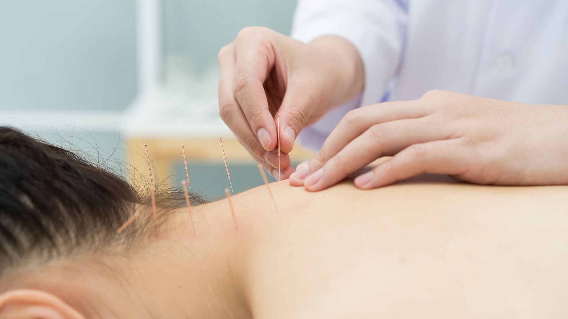 Practitioner inserting acupuncture needles into a patient’s back during a treatment session