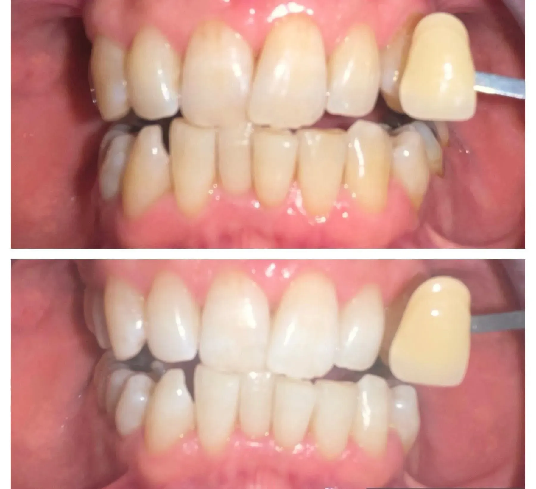 Teeth - Before & After