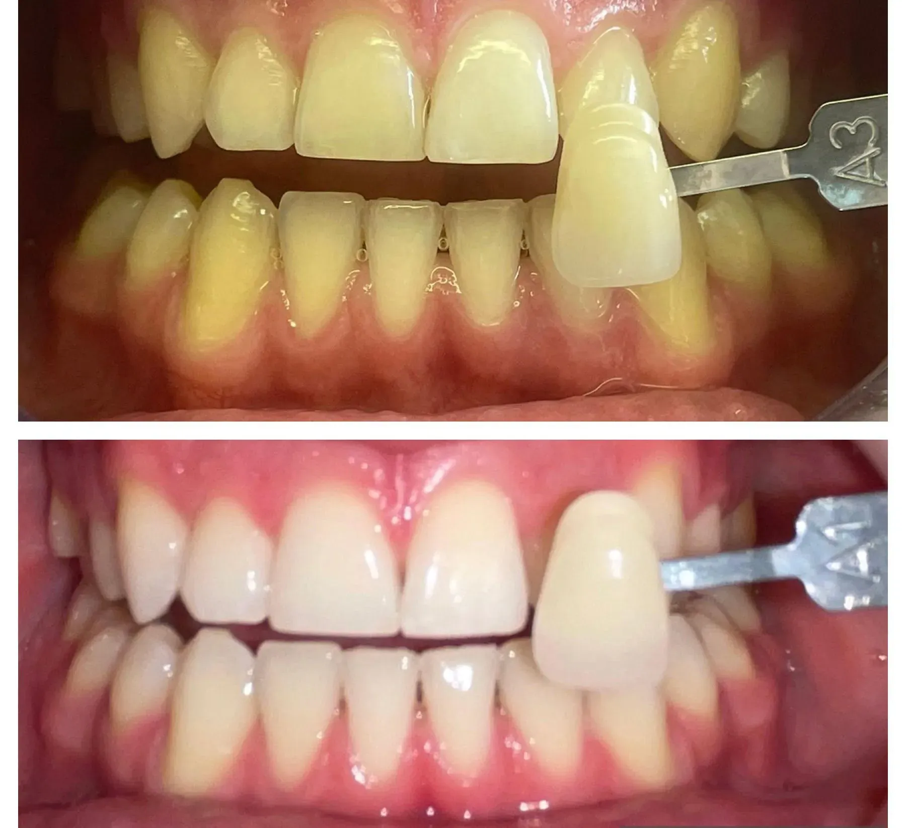 Teeth - Before & After