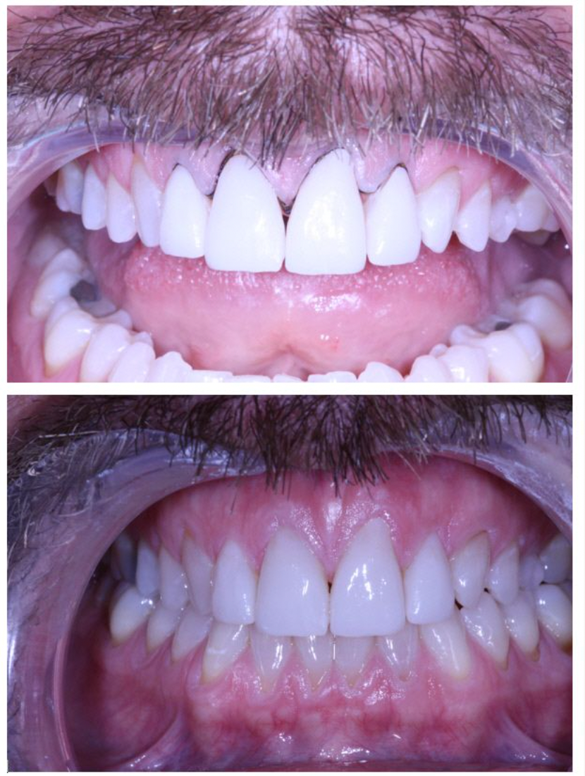 Teeth Whitening
