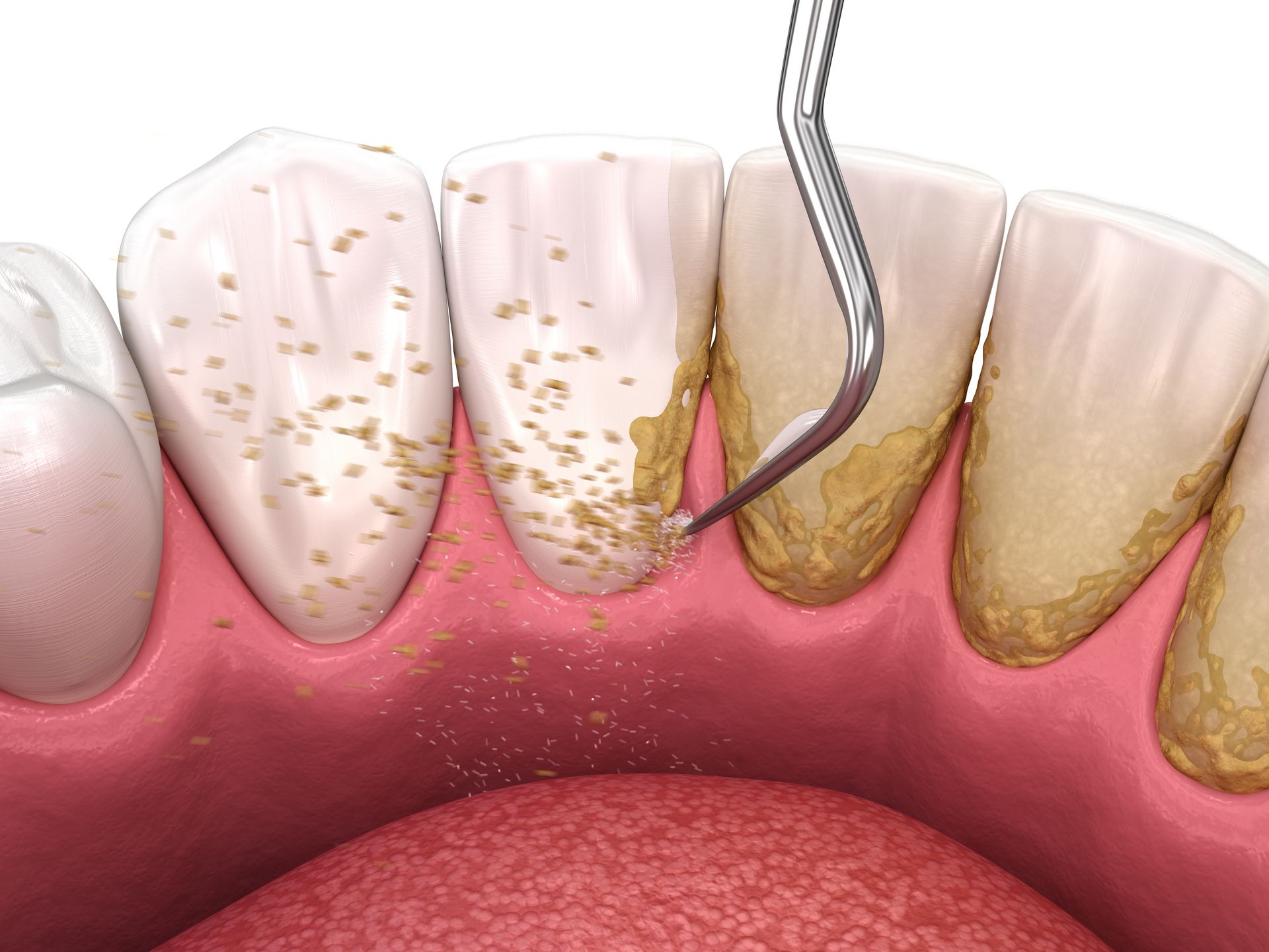 dental root planing