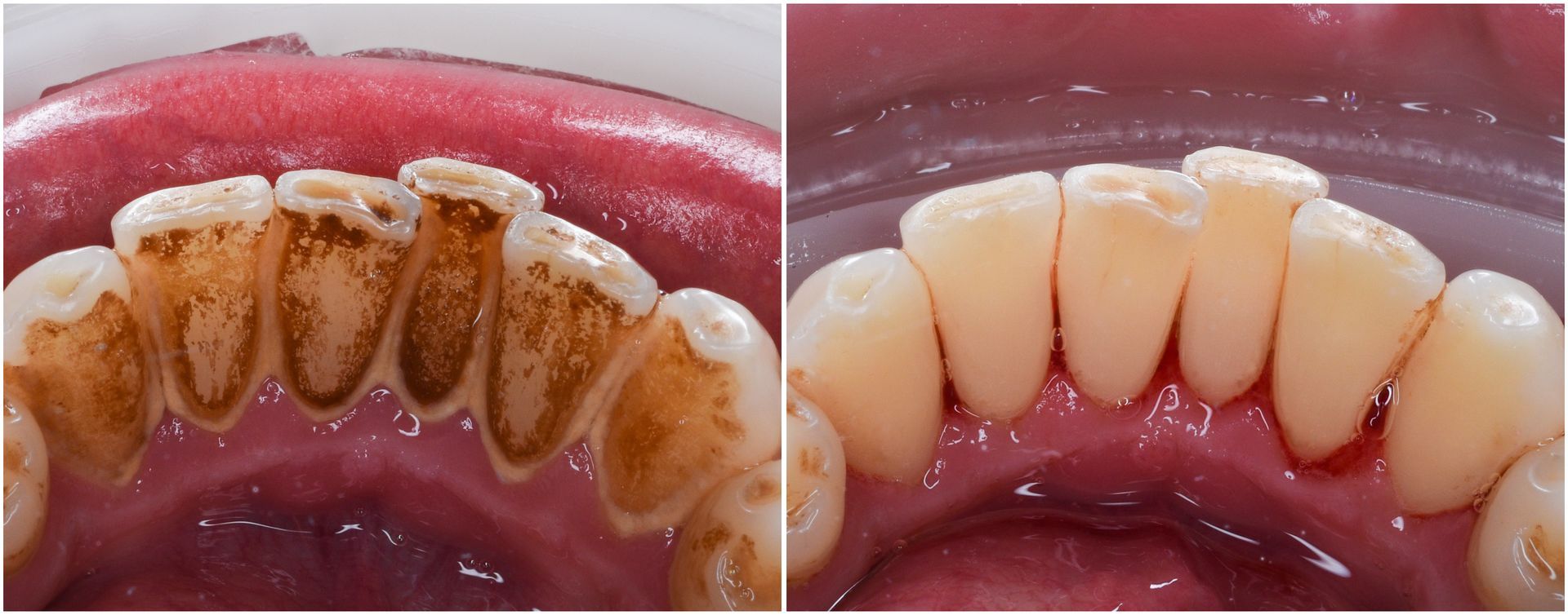 dental crowns in Attleboro, MA